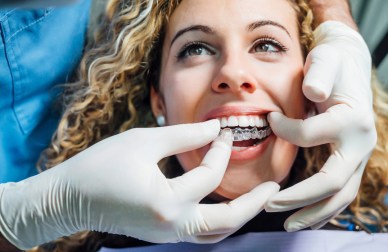 Frenillos invisibles precio en OnSmile Santiago