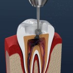 Endodoncia
