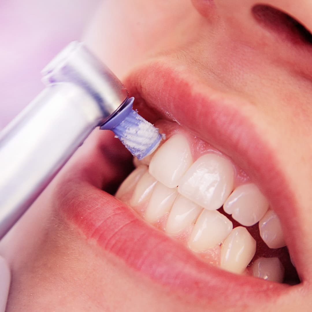 Profilaxis Dental