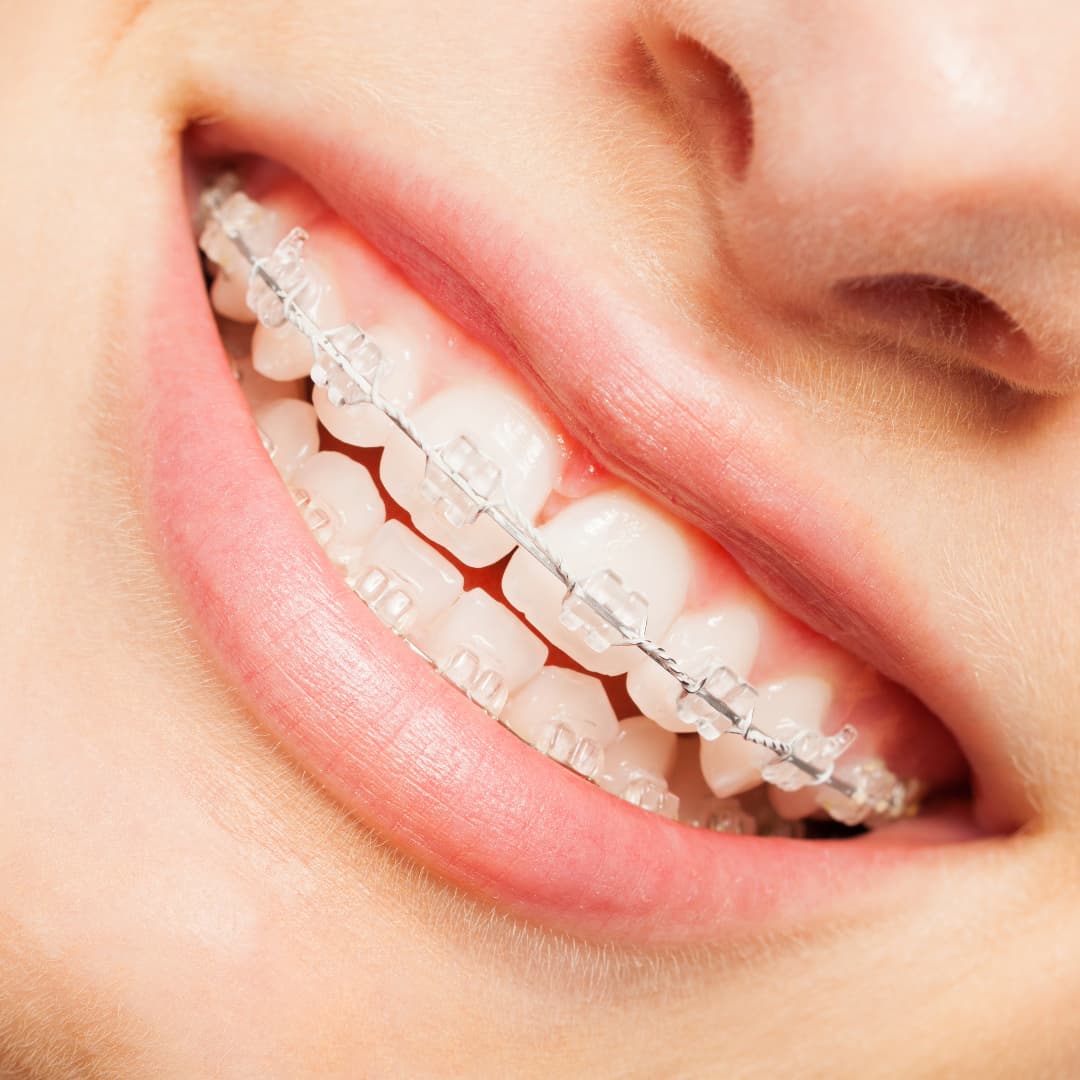 brackets de zafiro