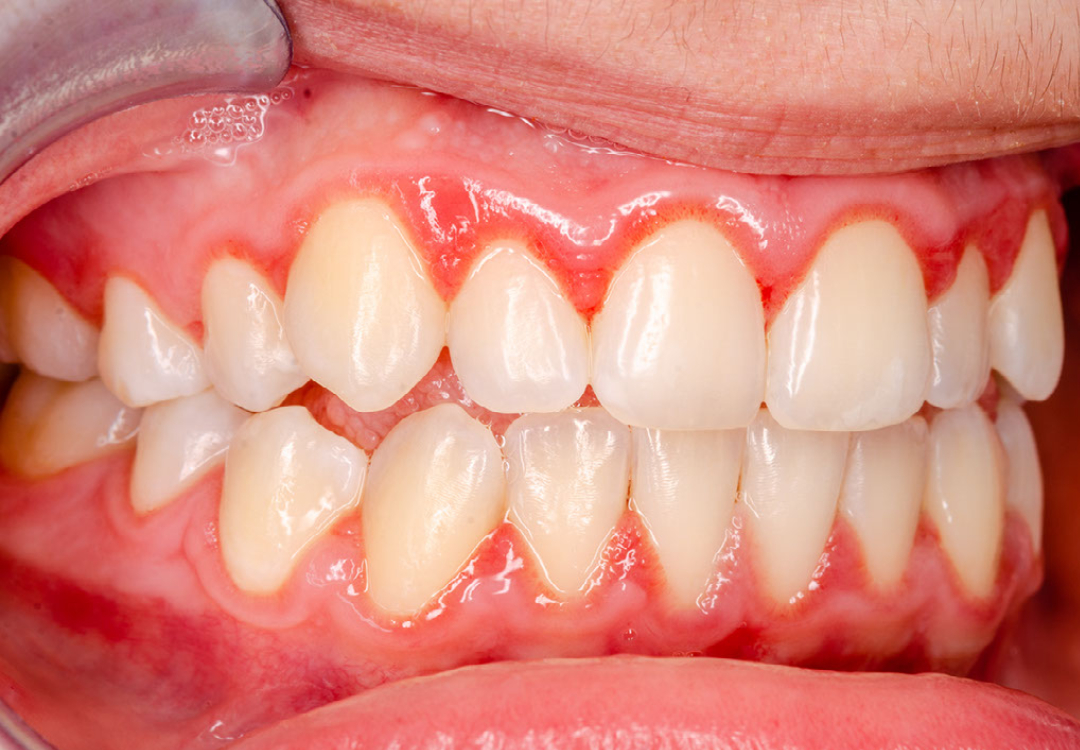 gingivitis